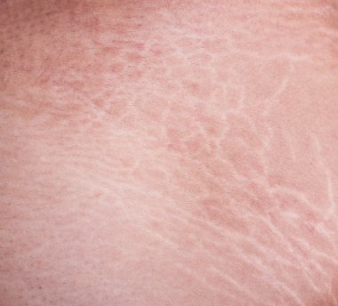 Uylukta cilt çatlakları