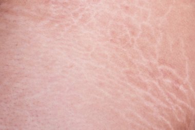 Uylukta cilt çatlakları