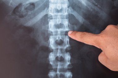 insan bir tıbbi tanı için x-ray görüntüsü