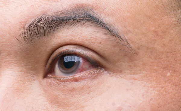 Eye Irritation Concept Macro Red Eye Man Conjunctivitis Eye Getting — Stock Photo, Image