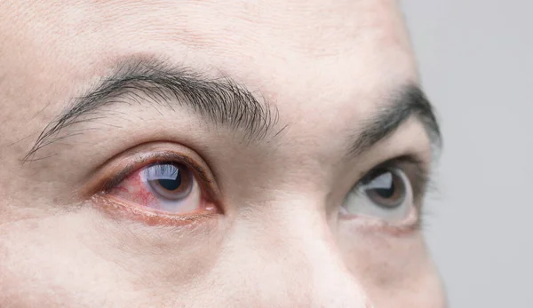 Eye Irritation Concept Macro Red Eye Man Conjunctivitis Eye Getting — Stock Photo, Image