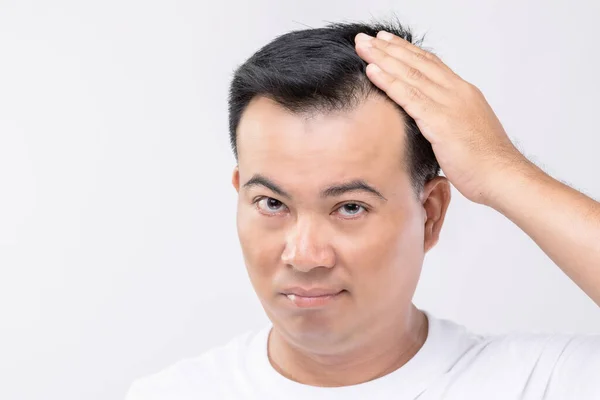 Portrait Asian Man Worry Feeling Touching His Head Show Bald — Stock Photo, Image