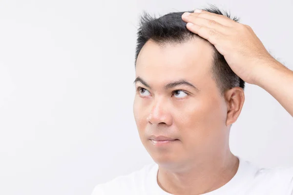 Portrait Asian Man Worry Feeling Touching His Head Show Bald — Stock Photo, Image