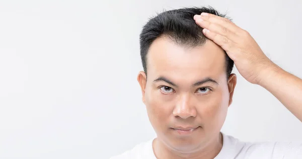 Portrait Asian Man Worry Feeling Touching His Head Show Bald — Stock Photo, Image