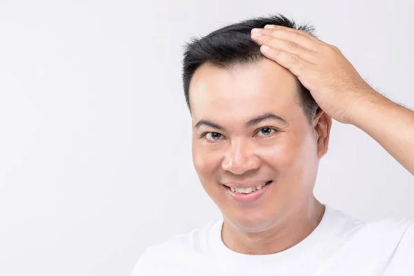 Portrait Happy Asian Man Touching His Head Show Bald Head — Stock Photo, Image