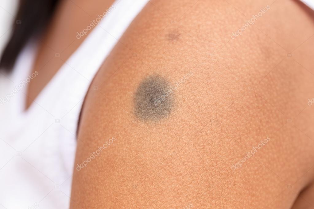 Close-up of black birthmark on skin