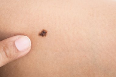 Birthmark on human skin clipart