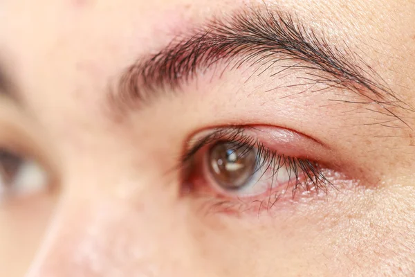 Left upper eyelid abscess — Stock Photo, Image