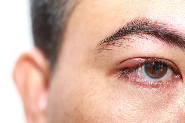 Right upper eyelid abscess — Stock Photo, Image