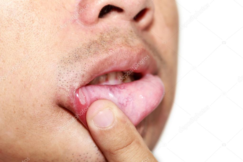 Man with aphtha on lip