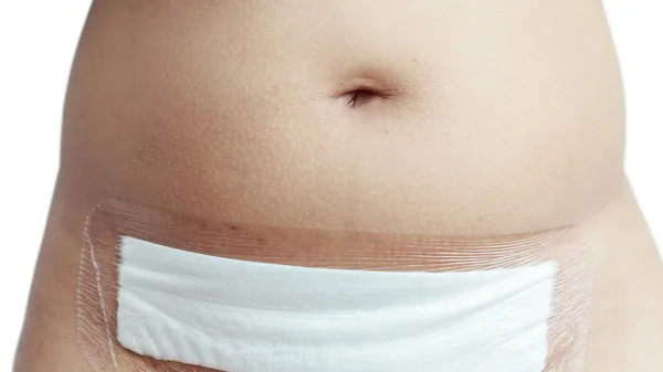 Paño blanco en el vientre de la mujer después de operar — Foto de Stock