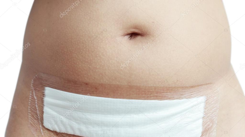 White cloth on woman belly after operate