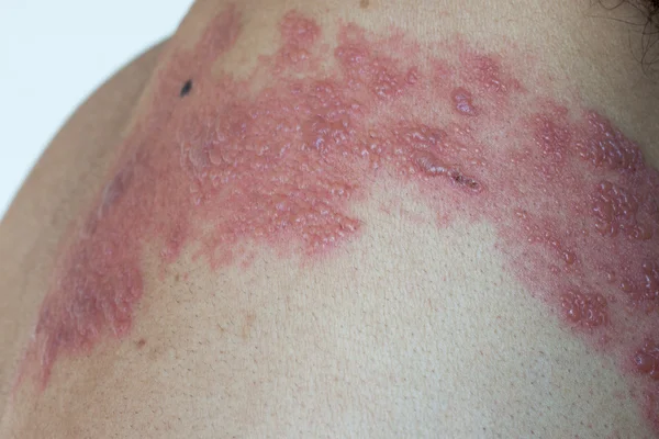 Herpes zoster (Gürtelrose)) — Stockfoto