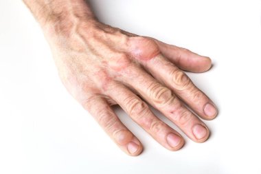 Beyaz arka planda bir adamın elinde korkunç yanıklar var..