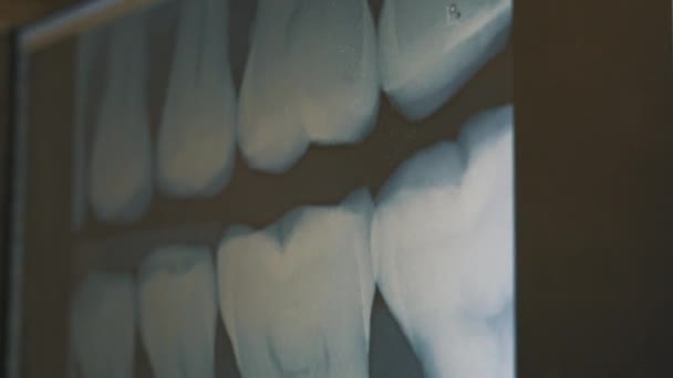 Raios-X dos dentes num ecrã de computador numa sala de raios-X. Analisando de tiros radiográficos de um paciente dentes. — Vídeo de Stock