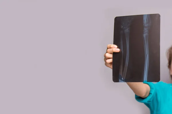 Αγόρι Κρατάει Την Ακτινογραφία Του Σπασμένο Χέρι — Φωτογραφία Αρχείου