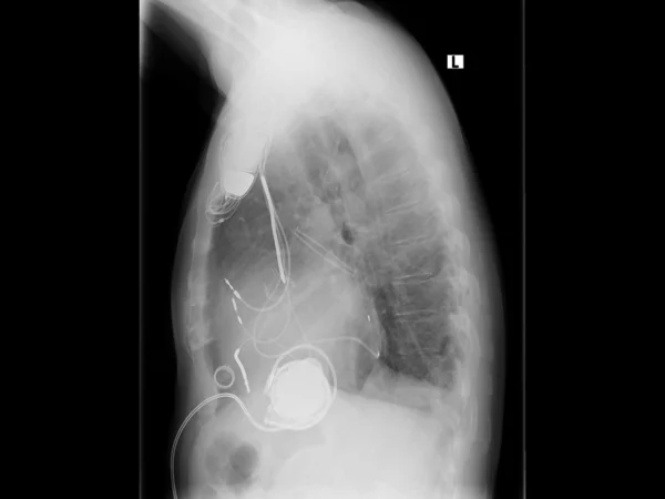 Radiografía, pecho, marcapasos cardíaco — Foto de Stock