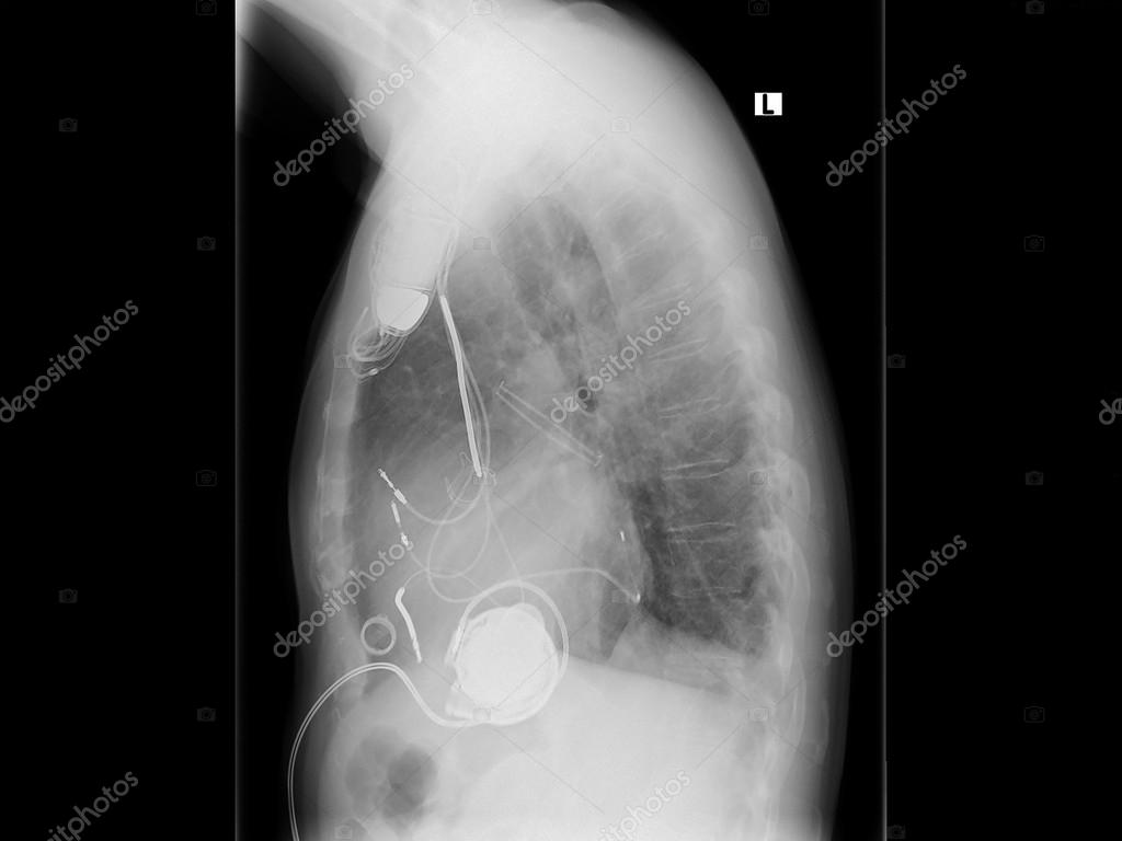 Radiograph, chest, heart pacemaker Stock Photo by ©NikD51 60613775