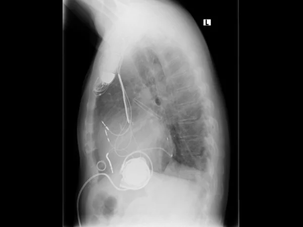Röntgenbild, Brust, Herzschrittmacher — Stockfoto