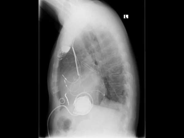 Radiografía, pecho, marcapasos cardíaco — Foto de Stock