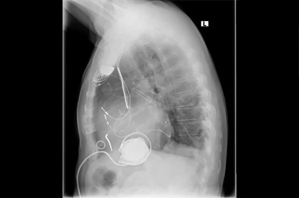 Imagen de rayos X, enlaces, marcapasos artificial del corazón — Foto de Stock