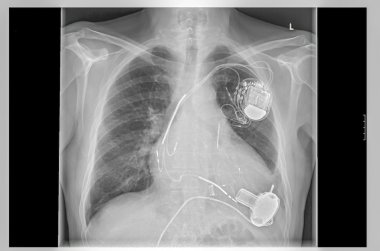 X-Ray görüntü, bağlantılar, yapay kalp pili