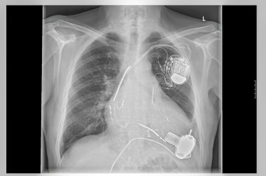X-ray image, links, artificial heart pacemaker clipart