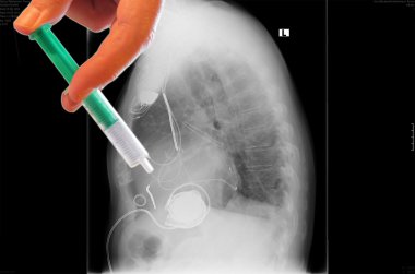 X-Ray görüntü, bağlantılar, yapay kalp pili