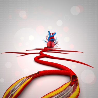 Bir balon yerleştirilmesi ile Stent anjiyoplasti yordamı