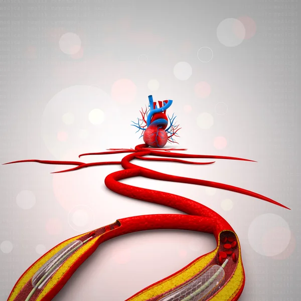 Stent angioplasty procedure with placing a balloon — Stock Photo, Image