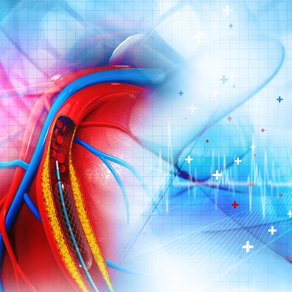 Procedimiento de angioplastia con stent para colocar un balón — Foto de Stock