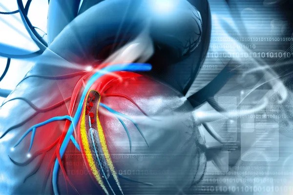 Bir balon yerleştirilmesi ile Stent anjiyoplasti yordamı