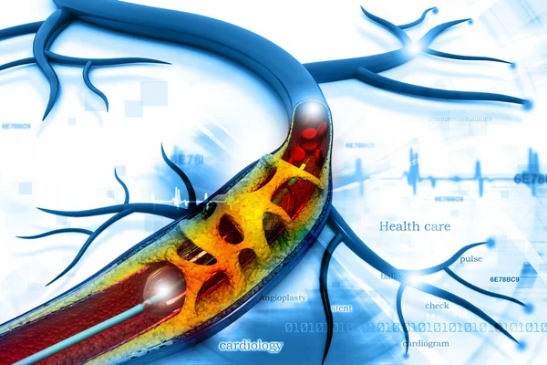 Procedimiento de angioplastia con stent para colocar un balón — Foto de Stock