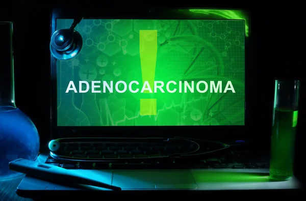Аденокарцинома — стоковое фото