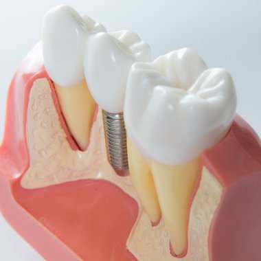 Dental implant clipart