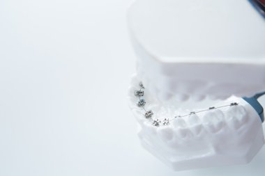 Diş alt çene aparatı modeli beyaz diş teli