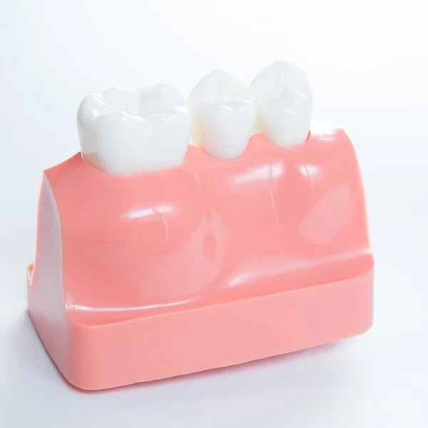 Close up of a Dental  implant model. — Stock Photo, Image