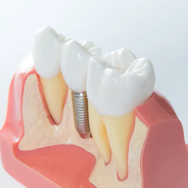 Fogászati implantátum — Stock Fotó