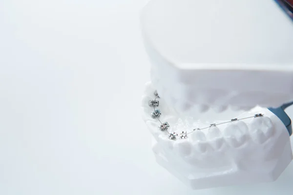 Dental lower jaw bracket braces model on white — Stock Photo, Image