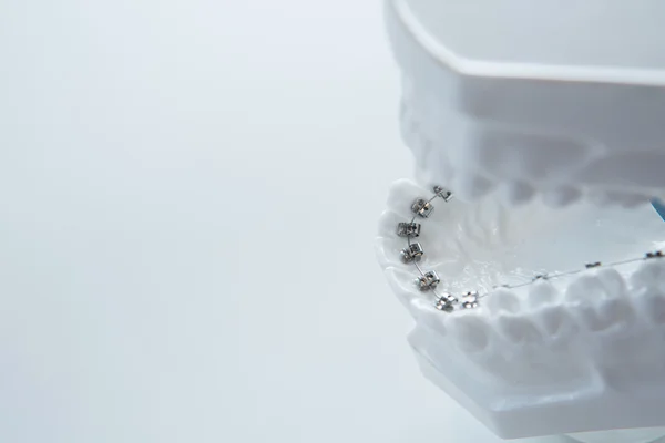 Dental lower jaw bracket braces model on white — Stock Photo, Image