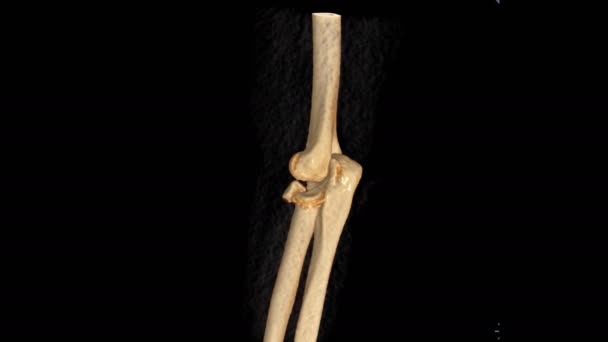 Ctエルボー3Dレンダリング画像は 半径骨の骨折を示しています — ストック動画