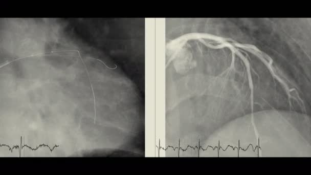 冠状动脉造影是用来检测冠状动脉狭窄程度的一种检查 用以检测心脏骤停 显示左冠状动脉 — 图库视频影像