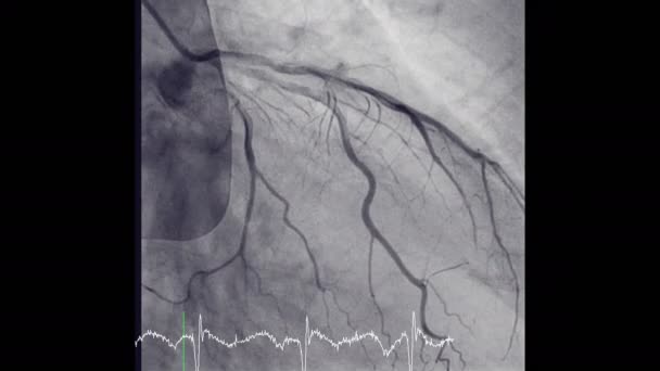 Angiografia Coronarica Test Usato Scoprire Quanto Restringimento Nelle Arterie Coronarie — Video Stock