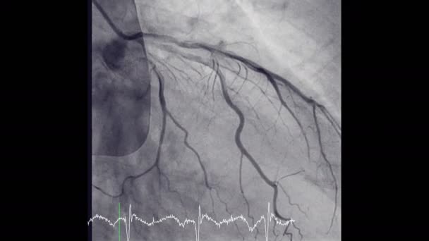 79 Angioplasty Videos, Royalty-free Stock Angioplasty Footage | Depositphotos 79 Angioplasty Videos, Royalty-free Stock Angioplasty Footage | Depositphotos
