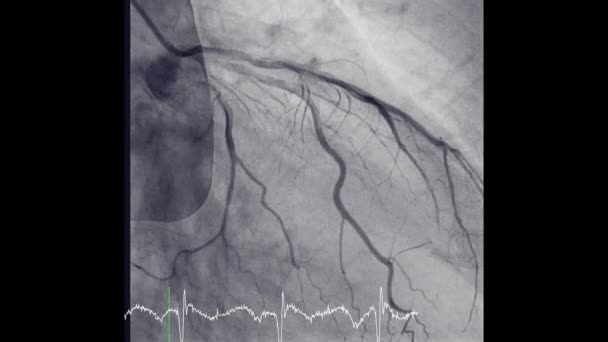 Angiographie Coronarienne Est Test Utilisé Pour Savoir Combien Rétrécissement Dans — Video