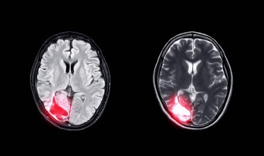 Compare MRI brain  Axial T2W flair and T2W view  for showing enchepalomalacia disease. clipart