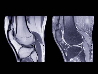 Magnetic resonance imaging or MRI knee comparison sagittal PDW and TIW view for detect tear or sprain of the anterior cruciate  ligament (ACL).clipping path. clipart