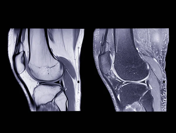 Ressonância Magnética Comparação Joelho Mri Sagital Pdw Tiw Vista Para — Fotografia de Stock