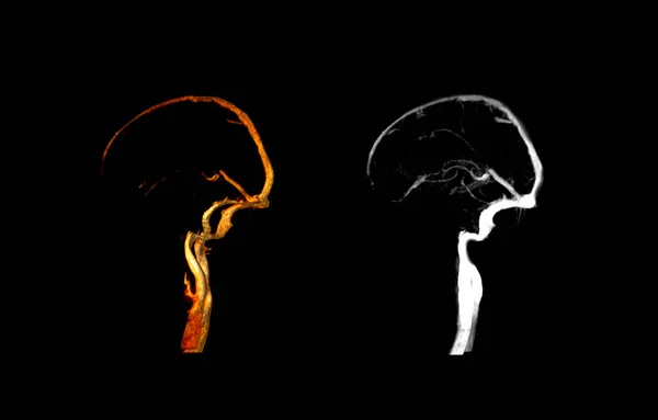 Ctv Brain Oldalnézet Összehasonlítani Mip Kép — Stock Fotó