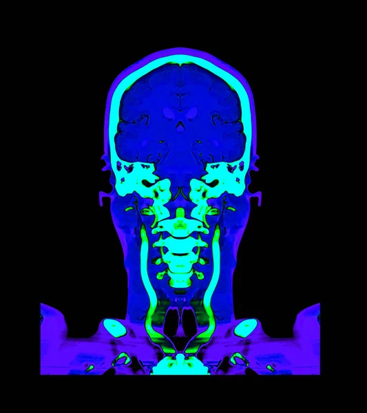 Kolekcja Kolorowe Angiografii Mózgu Lub Cta Porównania Mózgu Coronal View — Zdjęcie stockowe